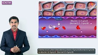 1Edema introduction  Hemodynamic pathology Fmge Neet PG and usmle [upl. by Tj]