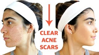 CLEAR ACNE SCARS FAST  DIY Face Masks That WORK [upl. by Pan]