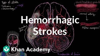 Hemorrhagic strokes  Circulatory System and Disease  NCLEXRN  Khan Academy [upl. by Pyle148]