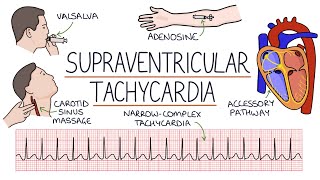 Understanding Supraventricular Tachycardia SVT [upl. by Boony]