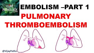 EMBOLISM Part 1 Pulmonary amp Systemic thromboembolism [upl. by Ydnem]